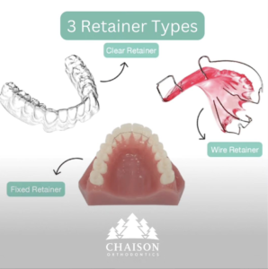 3 Retainer Types from Chaison Orthodontics, Everett WA